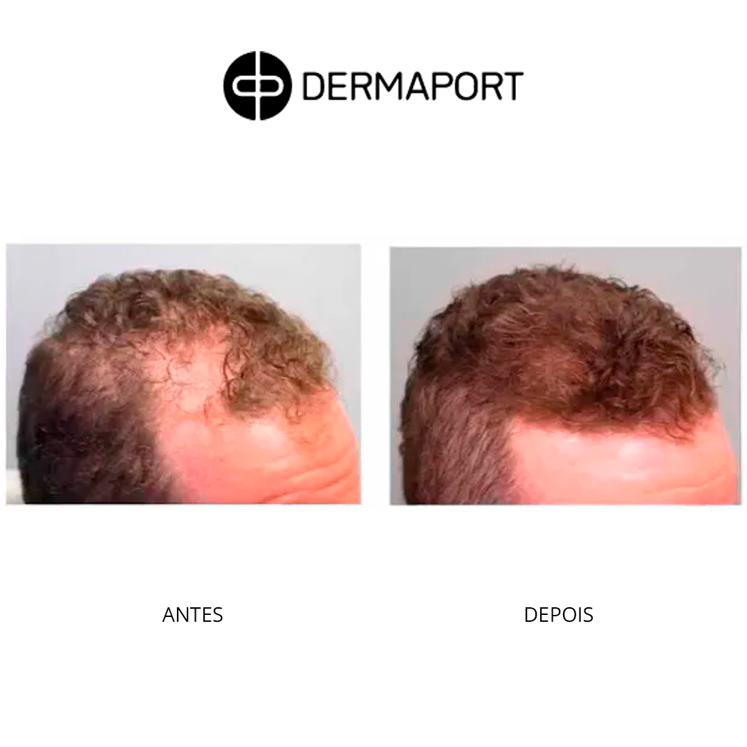 dermaport-ad5